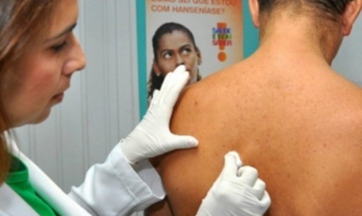 Janeiro Roxo: Brasil é o 2º país com mais casos de hanseníase