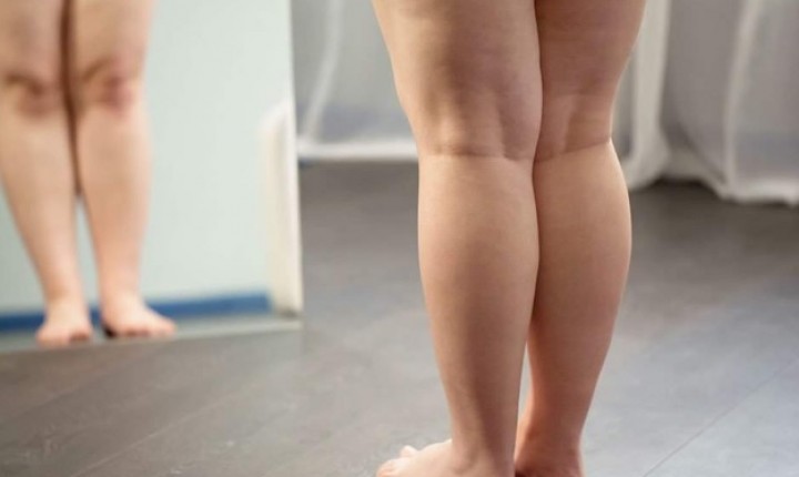 Como a alimentação pode melhorar os sintomas do lipedema