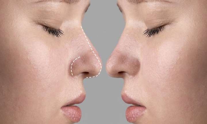 Entenda quando a cirurgia do nariz é necessária