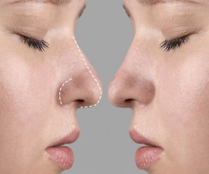 Entenda quando a cirurgia do nariz é necessária
