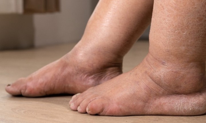 Tem lipedema? Veja o que evitar agora