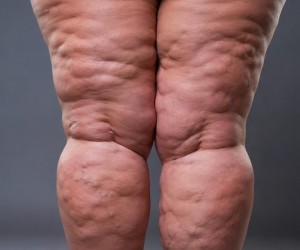 Lipedema no verão: por que as pernas sofrem mais?
