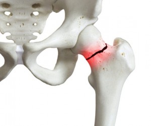 Fratura de fêmur: Entenda os riscos para os idosos