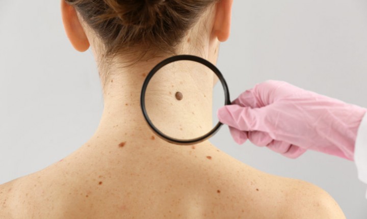 Saiba como identificar o câncer de pele no início