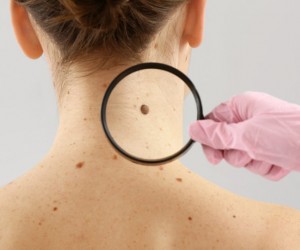 Saiba como identificar o câncer de pele no início