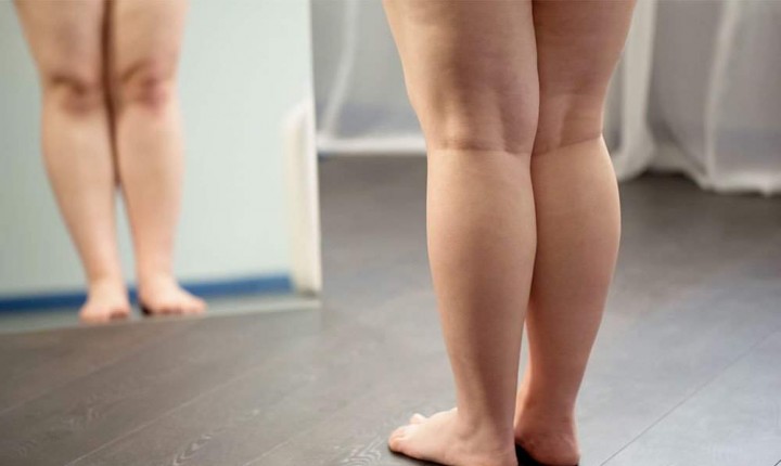 Lipidema: condição revela sinais ocultos